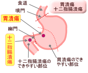 Diagram of gastric ulcer and duodenal ulcer