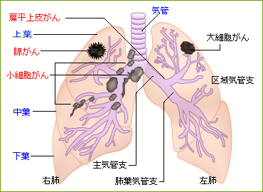 肺がんの説明図