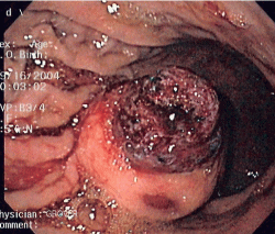 GIST:消化管間質腫瘍写真