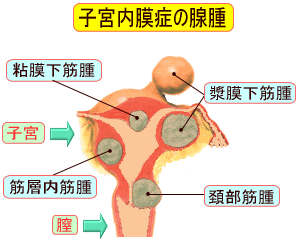 Endometriotic adenoma